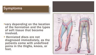  symptoms of a herniated disc can
vary depending on the location
of the herniation and the types
of soft tissue that become
involved.
 Herniated discs are not
diagnosed immediately, as the
patients come with undefined
pains in the thighs, knees, or
feet.
 