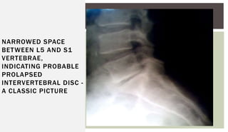 NARROWED SPACE
BETWEEN L5 AND S1
VERTEBRAE,
INDICATING PROBABLE
PROLAPSED
INTERVERTEBRAL DISC -
A CLASSIC PICTURE
 