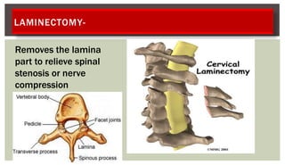 LAMINECTOMY-
Removes the lamina
part to relieve spinal
stenosis or nerve
compression
 