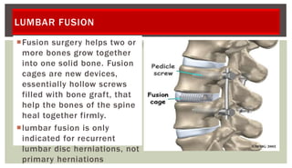 LUMBAR FUSION
Fusion surgery helps two or
more bones grow together
into one solid bone. Fusion
cages are new devices,
essentially hollow screws
filled with bone graft, that
help the bones of the spine
heal together firmly.
lumbar fusion is only
indicated for recurrent
lumbar disc herniations, not
primary herniations
 