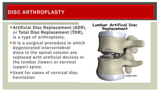 DISC ARTHROPLASTY
Artificial Disc Replacement (ADR),
or Total Disc Replacement (TDR),
is a type of arthroplasty.
It is a surgical procedure in which
degenerated intervertebral
discs in the spinal column are
replaced with artificial devices in
the lumbar (lower) or cervical
(upper) spine.
Used for cases of cervical disc
herniation
 