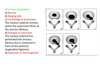 Schematic illustration
a) Normal
b) Bulging disk
c) Focal bulge or protrusion.
The nucleus material remains
within the outermost fibres of
the annulus fibrosus.
d) Prolapse or extrusion.
The nucleus material has
penetrated the annulus
fibrosus but is contained in
front of the posterior
longitudinal ligament.
e) Sequester or free fragment.
 