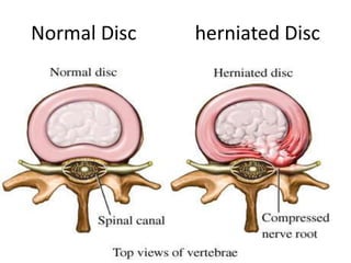 Normal Disc   herniated Disc
 