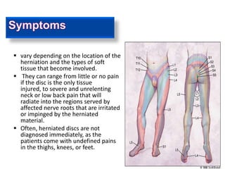  symptoms of a herniated disc can




 vary depending on the location of the
  herniation and the types of soft
  tissue that become involved.
 They can range from little or no pain
  if the disc is the only tissue
  injured, to severe and unrelenting
  neck or low back pain that will
  radiate into the regions served by
  affected nerve roots that are irritated
  or impinged by the herniated
  material.
 Often, herniated discs are not
  diagnosed immediately, as the
  patients come with undefined pains
  in the thighs, knees, or feet.
 