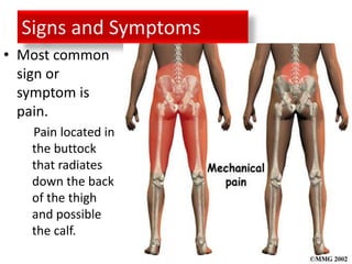 Signs and Symptoms
• Most common
  sign or
  symptom is
  pain.
   Pain located in
   the buttock
   that radiates
   down the back
   of the thigh
   and possible
   the calf.
 