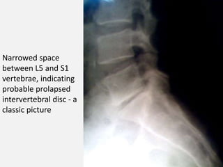 Narrowed space
between L5 and S1
vertebrae, indicating
probable prolapsed
intervertebral disc - a
classic picture
 