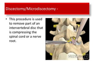 Discectomy/Microdiscectomy -

• This procedure is used
  to remove part of an
  intervertebral disc that
  is compressing the
  spinal cord or a nerve
  root.
 