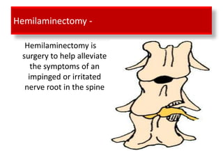 Hemilaminectomy -

  Hemilaminectomy is
 surgery to help alleviate
    the symptoms of an
   impinged or irritated
  nerve root in the spine
 