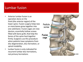 Lumbar fusion

•   Anterior lumbar fusion is an
    operation done on the
    front (the anterior region) of the
    lower spine. Fusion surgery helps two
    or more bones grow together into
    one solid bone. Fusion cages are new
    devices, essentially hollow screws
    filled with bone graft, that help the
    bones of the spine heal together
    firmly. Surgeons use this procedure
    when patients have symptoms from
    disc degeneration, disc herniation, or
    spinal instability.
•   lumbar fusion is only indicated for
    recurrent lumbar disc herniations,
    not primary herniations
 