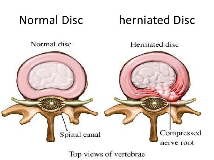 prolapsed intervertebral disk