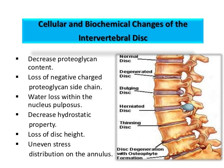 Intervertibral disc prolapse