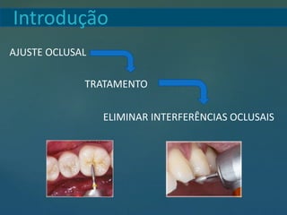 Introdução
AJUSTE OCLUSAL
TRATAMENTO
ELIMINAR INTERFERÊNCIAS OCLUSAIS
 