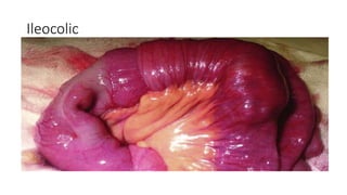Ileocolic
 