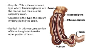 • Ileocolic : This is the commonest
type where ileum invaginates into
the caecum and then into the
ascending colon.
• Cecocolic:In this type ,the caecum
invaginates into the colon.
• Ileoileal : In this type ,one portion
of ileum invaginates into the
other portion of ileum.
 