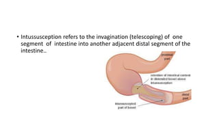 • Intussusception refers to the invagination (telescoping) of one
segment of intestine into another adjacent distal segment of the
intestine..
 