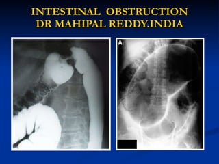 INTESTINAL  OBSTRUCTION DR MAHIPAL REDDY.INDIA 