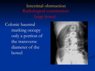 Intestinal obstruction Colonic haustral marking occupy only a portion of the transverse diameter of the bowel Radiological examination large bowel  