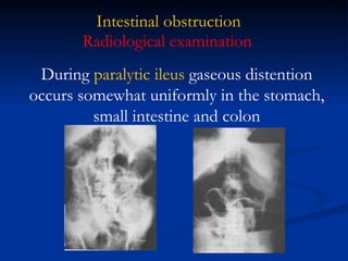 Intestinal obstruction Radiological examination During  paralytic ileus  gaseous distention occurs somewhat uniformly in the stomach, small intestine and colon 