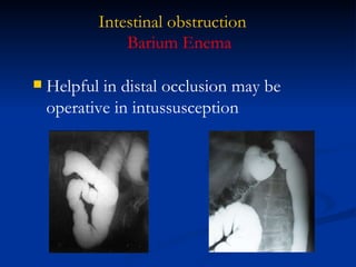 Intestinal obstruction Helpful in distal occlusion may be operative in intussusception  Barium Enema 