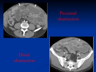 Proximal obstruction Distal obstruction 