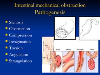 Intestinal   mechanical   obstruction Pathogenesis Stenosis Obstruction  Compression Invagination Torsion Angulation Strangulation 
