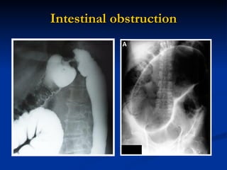 Intestinal   obstruction 
