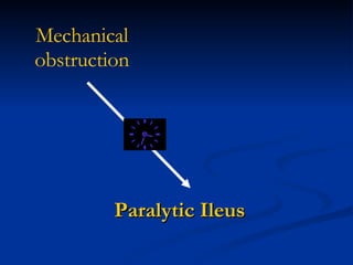 Paralytic Ileus Mechanical   obstruction 