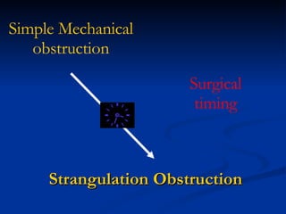 Strangulation Obstruction Simple Mechanical   obstruction Surgical timing 