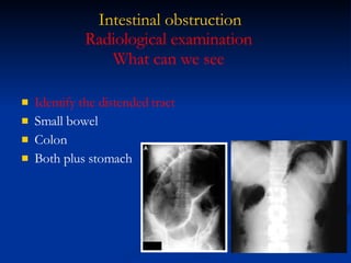 Intestinal obstruction Identify the distended tract Small bowel Colon Both plus stomach Radiological examination What can we see 