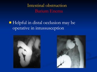 Intestinal obstruction Helpful in distal occlusion may be operative in intussusception  Barium Enema 