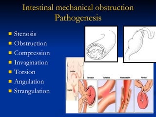 Intestinal   mechanical   obstruction Pathogenesis Stenosis Obstruction  Compression Invagination Torsion Angulation Strangulation 