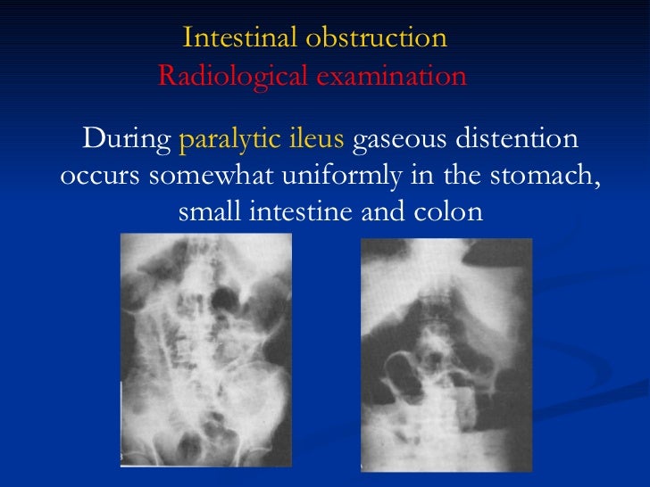 Intestinal Obstruction