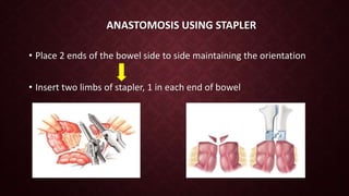 Intestinal anastomosis and staplers | PPTX