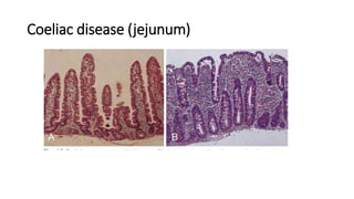 Coeliac disease (jejunum)
 