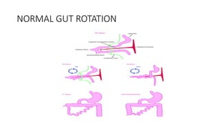 INTESTINAL MALROTATION EXPLAINED; spot the signs before a Medical ...