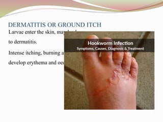 DERMATITIS OR GROUND ITCH
Larvae enter the skin, may lead
to dermatitis.
Intense itching, burning and
develop erythema and oedema.
 