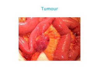 Tumour
 