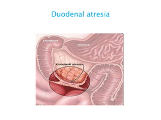 Duodenal atresia
 