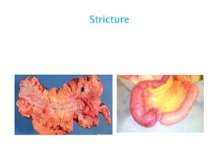 Stricture
 