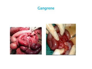 Gangrene
 
