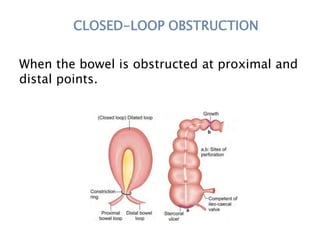 CLOSED-LOOP OBSTRUCTION
When the bowel is obstructed at proximal and
distal points.
 