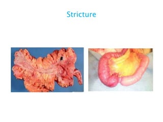 Stricture
 