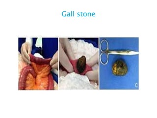 Gall stone
 