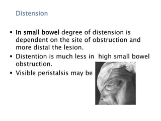 Distension
 In small bowel degree of distension is
dependent on the site of obstruction and
more distal the lesion.
 Distention is much less in high small bowel
obstruction.
 Visible peristalsis may be present
 