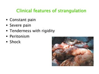 Clinical features of strangulation
 Constant pain
 Severe pain
 Tenderness with rigidity
 Peritonism
 Shock
 