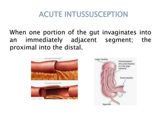 ACUTE INTUSSUSCEPTION
When one portion of the gut invaginates into
an immediately adjacent segment; the
proximal into the distal.
 