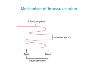 Mechanism of intussusception
 