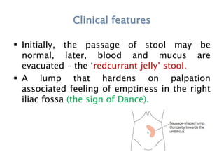 Clinical features
 Initially, the passage of stool may be
normal, later, blood and mucus are
evacuated – the ‘redcurrant jelly’ stool.
 A lump that hardens on palpation
associated feeling of emptiness in the right
iliac fossa (the sign of Dance).
 