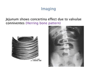 Imaging
Jejunum shows concertina effect due to valvulae
conniventes (Herring bone pattern)
 