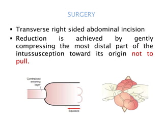 SURGERY
 Transverse right sided abdominal incision
 Reduction is achieved by gently
compressing the most distal part of the
intussusception toward its origin not to
pull.
 